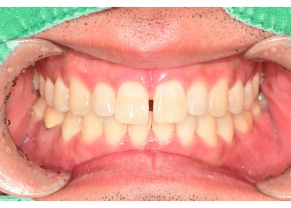 #11,21 Diastema