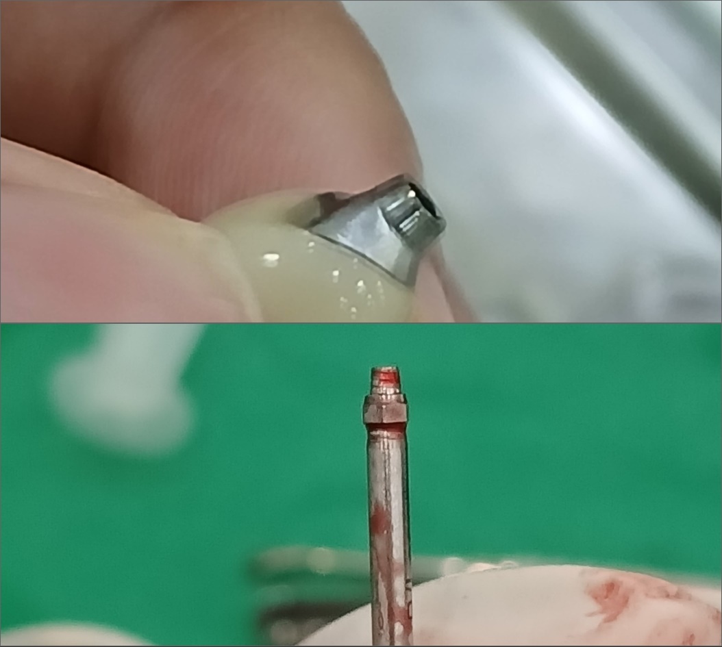 평택 임플란트 재수술