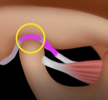 정복성 디스크 전방 변위 이미지